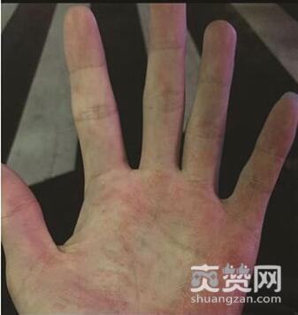 救人血掌照片走红,血掌,救人,爽赞网